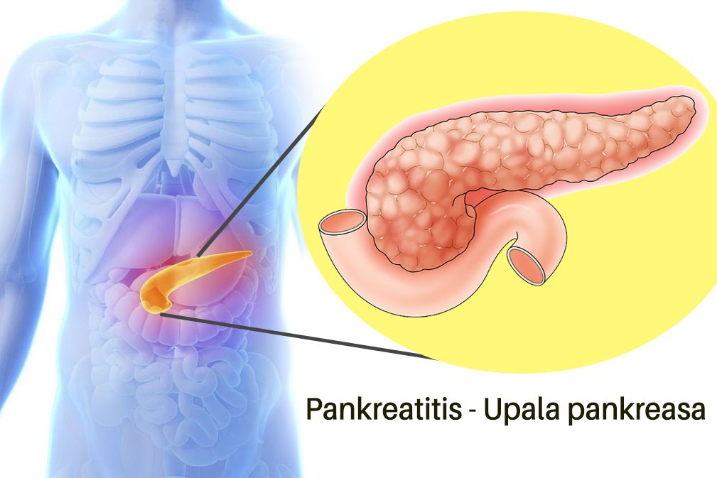 pankreatitis upala pankreasa gusterace
