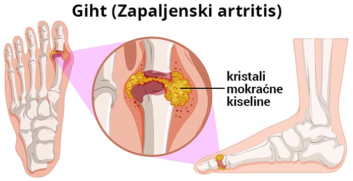 Crtež kako izgleda giht